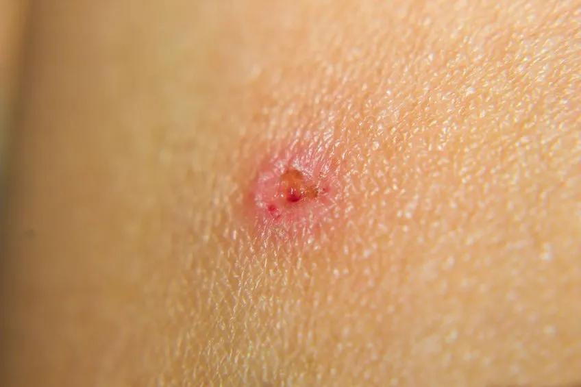 水痘春季高发怎么办,水痘高发期如何预防