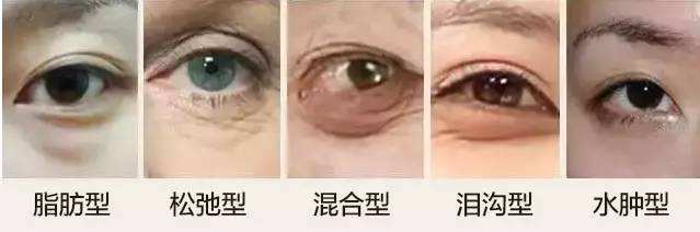 涂眼霜可以祛眼袋？不现实！祛眼袋的三种靠谱方法看这里