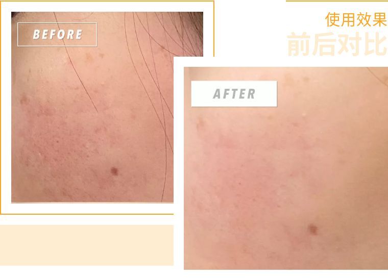 如何避免频繁戴口罩引起皮肤问题,戴口罩后护肤注意什么