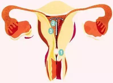 带环怀孕畸形的有吗,带环怀孕一定是宫外孕吗