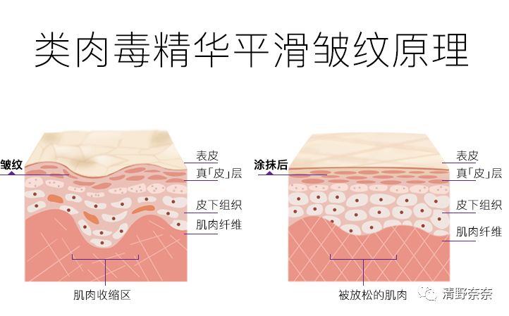 改善法令纹和川字纹抬头纹医美,祛除法令纹鱼尾纹最佳医美方法