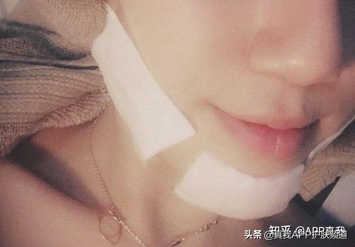 脸上闭口很多咋办啊我是敏感肌想试着刷酸请问有办法吗？