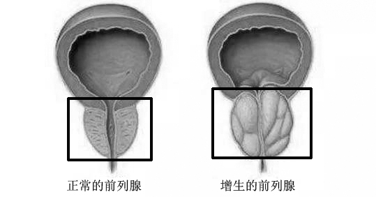 你有前列腺增生吗？需要早期治疗吗？这里给你答案