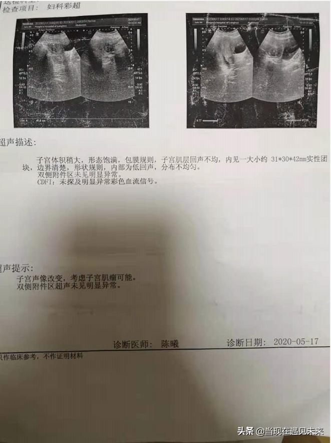 42岁子宫肌瘤备孕两个月没怀孕,备孕子宫肌瘤4厘米