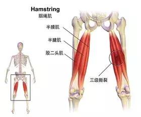 腘绳肌二级拉伤和三级拉伤的区别,大腿内侧拉伤韧带