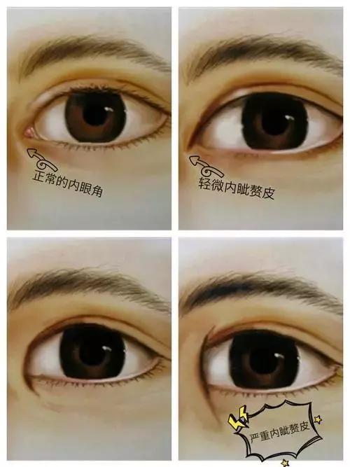 开眼角真的能变漂亮吗,开眼角能显眼睛大吗