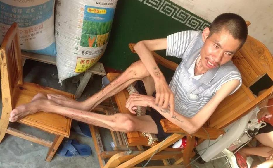 尘肺病是本世纪最严峻的问题,尘肺病发展到什么程度为一期