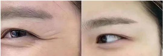 如何淡化眼纹记住这七大实用方法,已有眼纹该如何护理