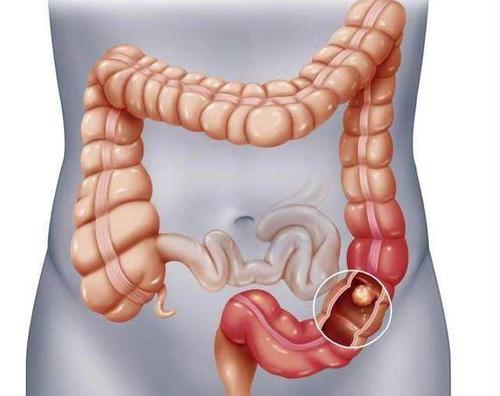 大肠息肉摘除后是否会再长?肠息肉切除后多长时间复查比较合适?