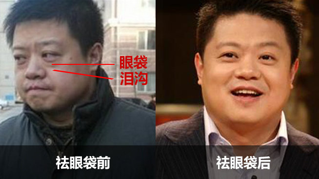 选择什么遮瑕可以遮住黑眼袋,男士遮瑕遮眼袋用什么好