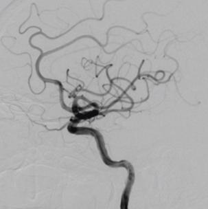 颈内动脉c3段动脉瘤是什么症状,右颈内动脉c3段动脉瘤是什么意思