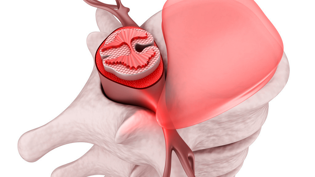 腰椎间盘突出微创3d手术恢复视频,腰椎间盘4-5节突出微创手术费用