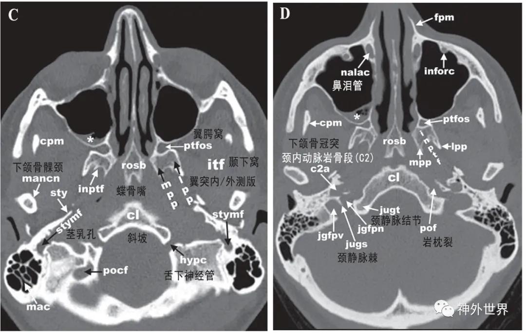 颅底骨折合并脑脊液漏伤情鉴定,颅底骨折伴脑脊液漏右眼眶骨折