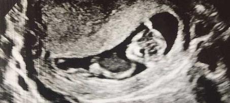 最特别的胎记，未出生的姐姐给胞弟留下的特殊回忆，让人感动