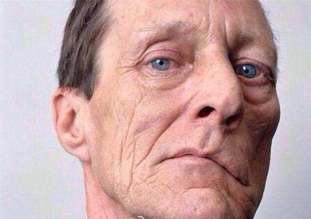 周围性面瘫恢复期的治疗方案,周围性面瘫怎么治疗效果最好