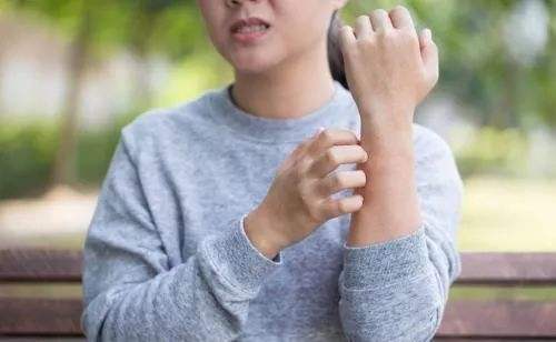 白癜风照完光发红发痒好还是不好,白癜风抹了卡力孜然酊发痒怎么治