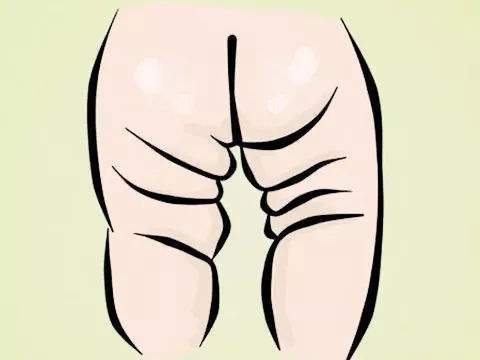 宝宝皮纹不对称腿好像粗细不一样,婴儿皮纹不对称多大治疗效果最好