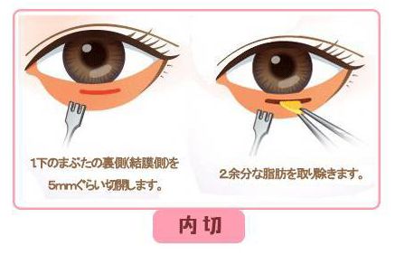 暂时性眼袋大什么原因引起的,暂时性眼袋怎么治疗