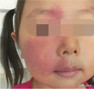 草莓斑胎记,草莓血管瘤胎记