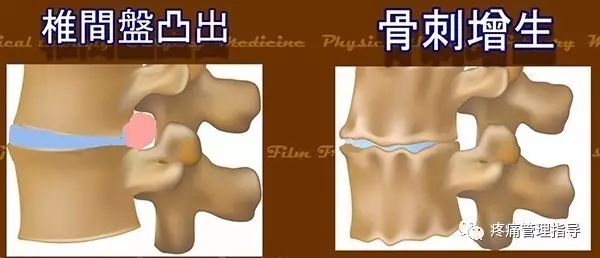 72岁老人腰疼还有骨刺该怎么治疗,老年人骨刺疼痛怎么治疗