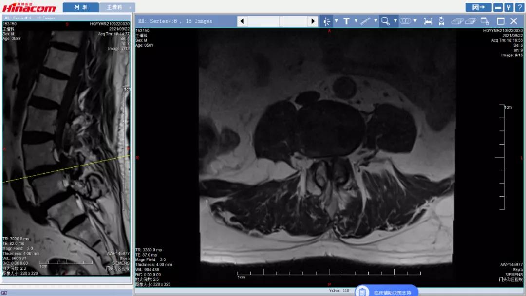 再也不用歪着身子走路了—区医院脊柱中心（骨二科）成功实施腰椎间盘摘除、椎间植骨融合钉棒内固定术