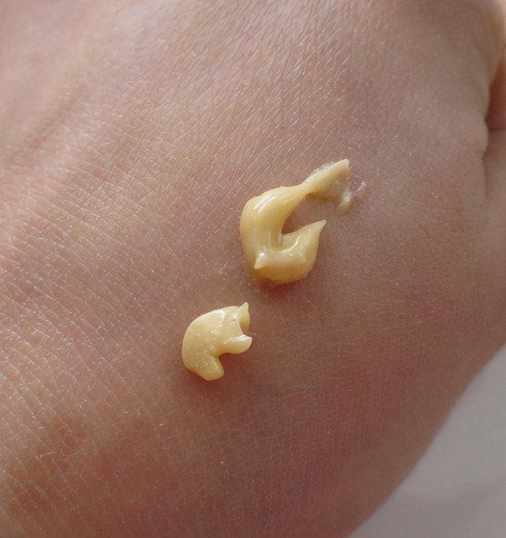 混合性肌肤t区出油怎么办,混合皮肤t区出油是什么原因