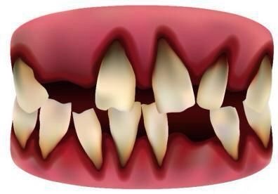 不健康牙齿,不健康牙齿颜色对照图