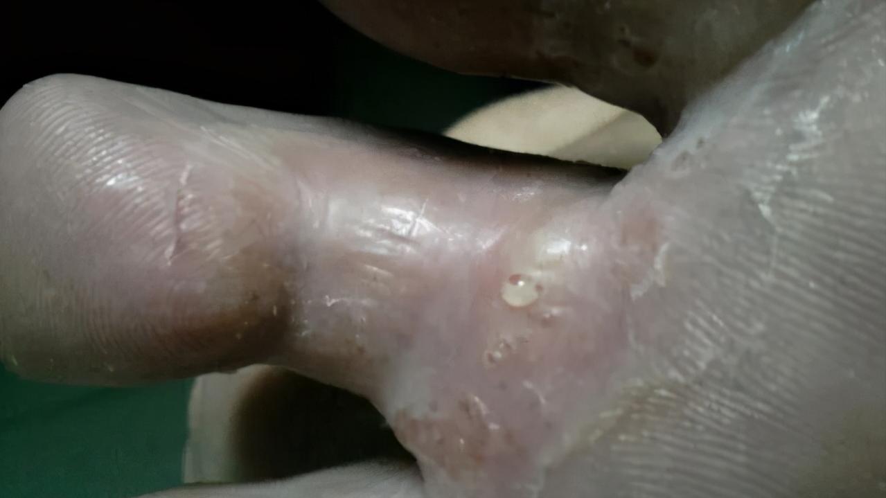脚上干裂居然是真菌惹的祸