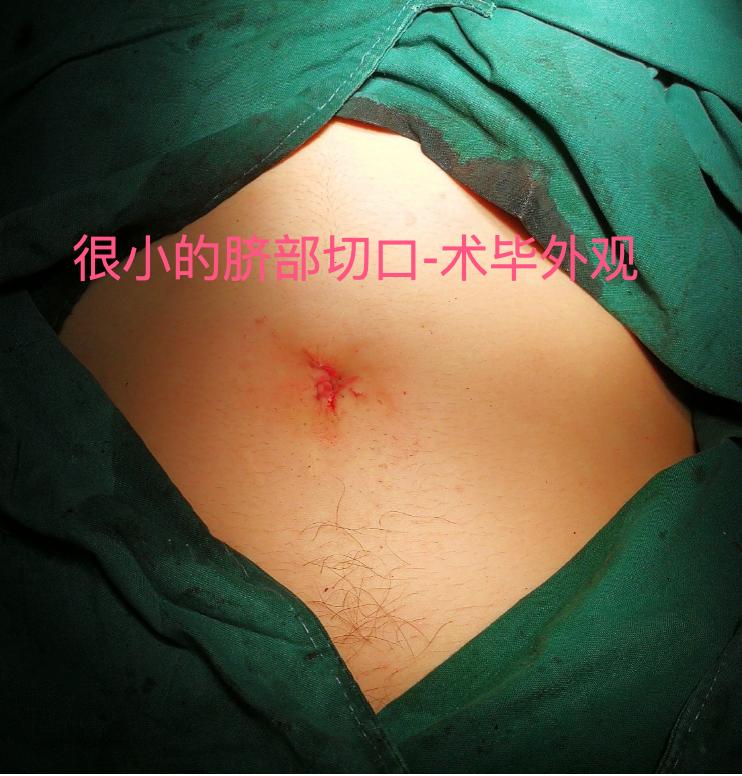 宫外孕微创手术的伤疤要涂什么药,宫外孕手术会不会留下伤疤