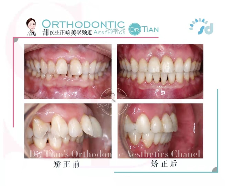 47岁大龄矫正,骨性嘴突+牙缝大+牙周炎|曹博士正畸复杂病例分享