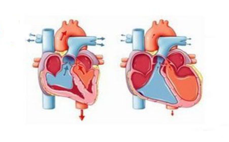 心梗不做搭桥能保守治疗吗,冠心病不支架可以治愈吗