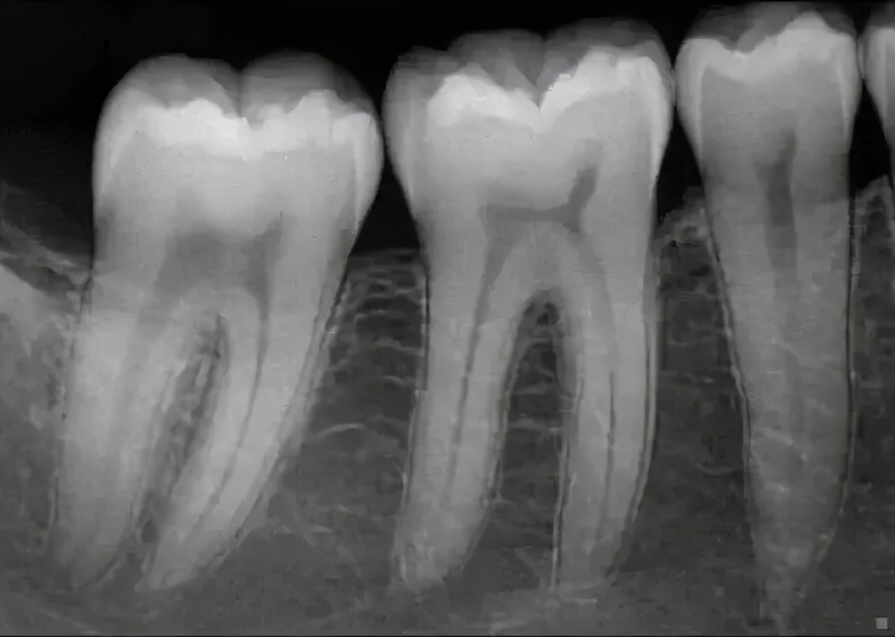 拍牙x光片对身体有什么危害,牙齿拍了几次x光片的危害