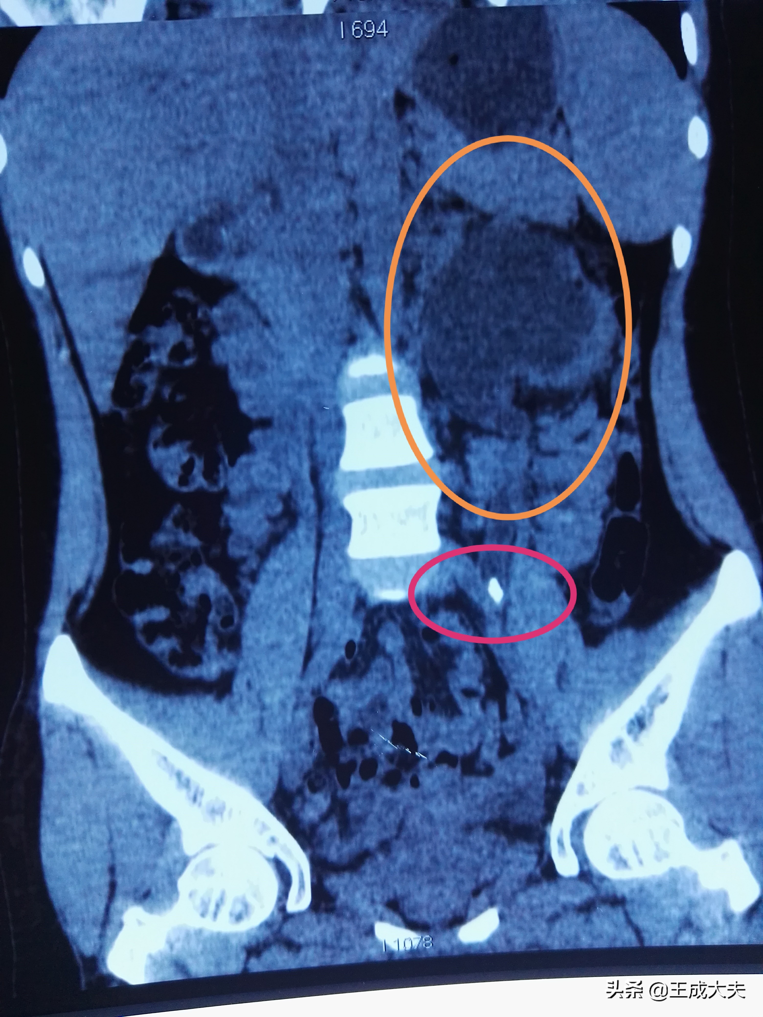关于尿路结石的病因说法不正确,结石方面辟谣
