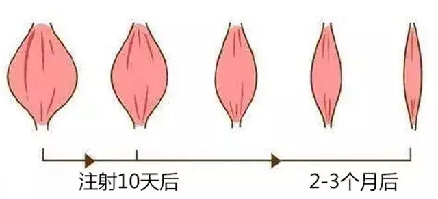 打瘦脸针后如何避免咬肌反弹,肉毒素瘦脸针怎么样避免碰到神经