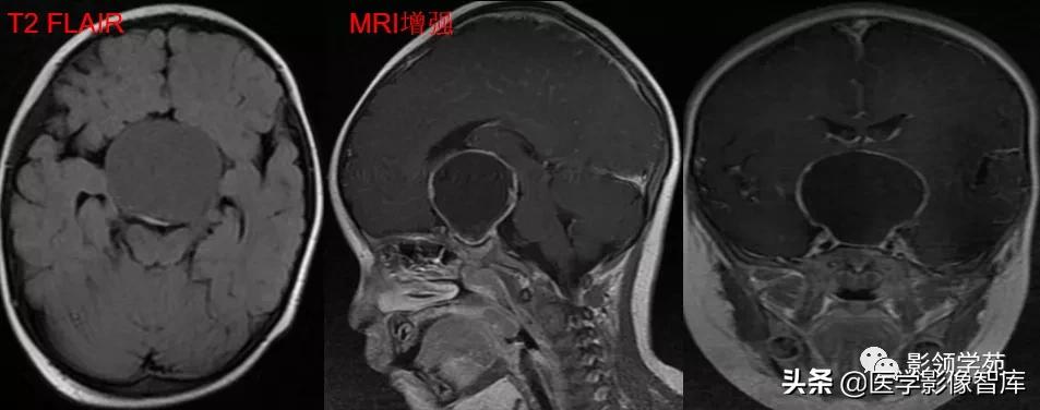 鞍区肿瘤做什么检查得出来,鞍区肿瘤的影像学鉴别