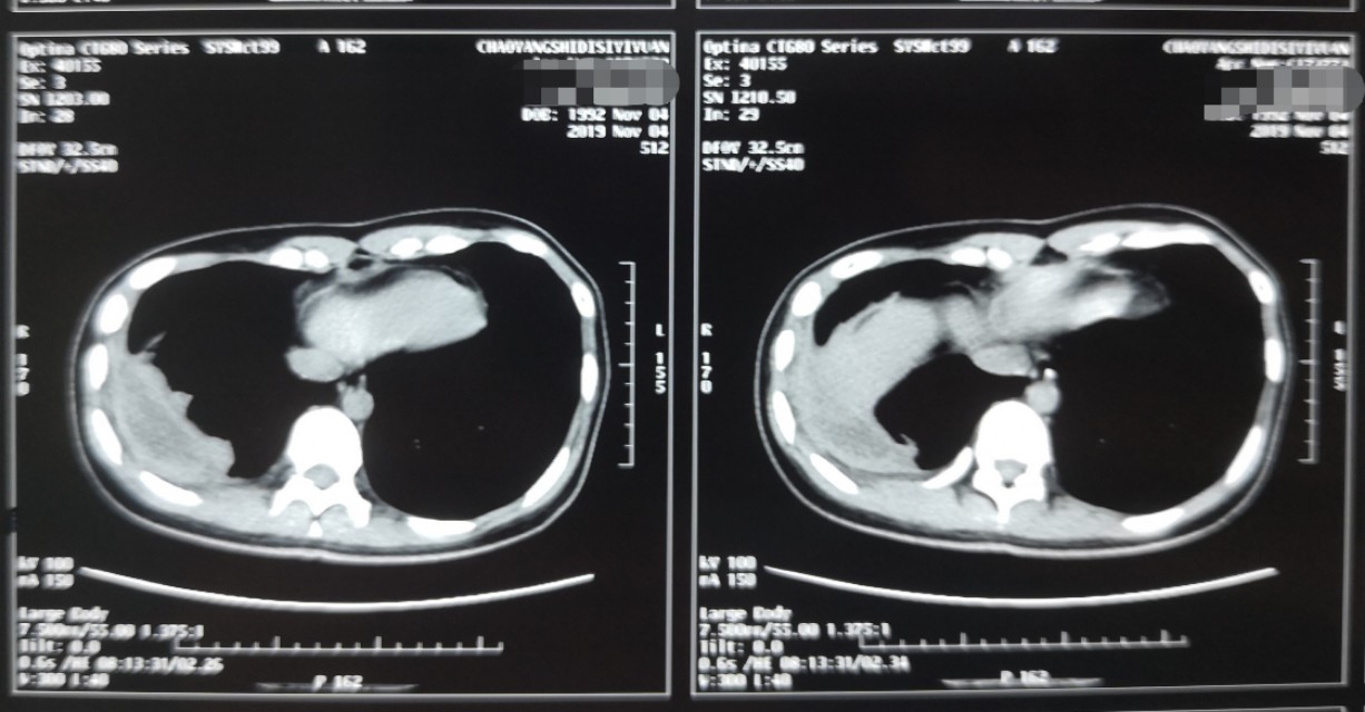 慢性脓胸手术费用报销,慢性脓胸哪里治得好