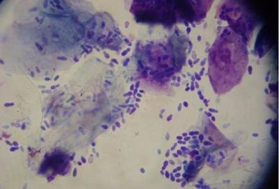 不是所有白斑都是白癜风,是不是所有的白斑都是白癜风