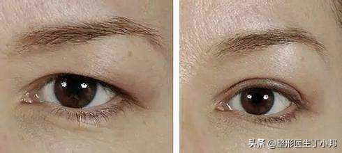 提眉术后注意事项及禁忌,提眉术细节处理