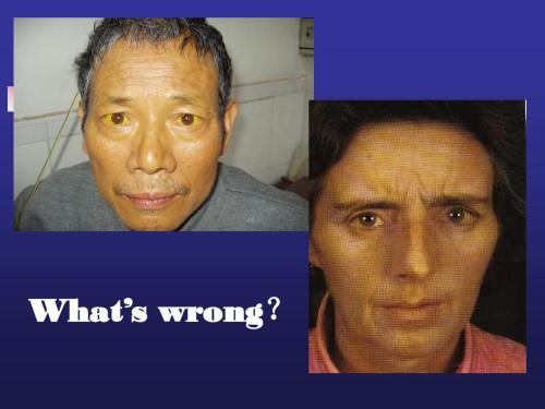 肝病引起的脸色发黄怎么治疗,肝病是什么问题引起颜色发黄