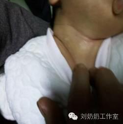 起白斑是什么原因,起白斑就是白癜风吗