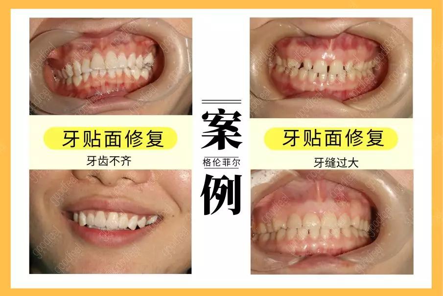 牙齿美白六种实用方法,牙齿美白的三种新方法