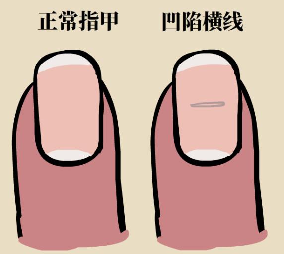 指甲上有凹痕是什么原因,指甲出现甲凹点是什么原因