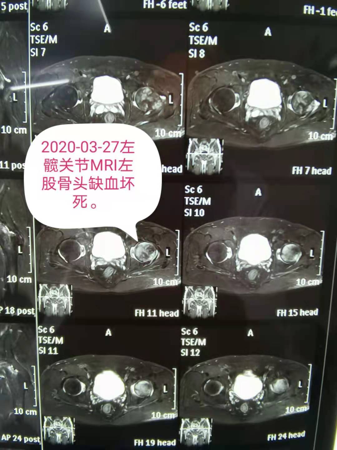 久久为功！水矿总医院以冲击波为主治疗一例股骨头坏死病例效果不错