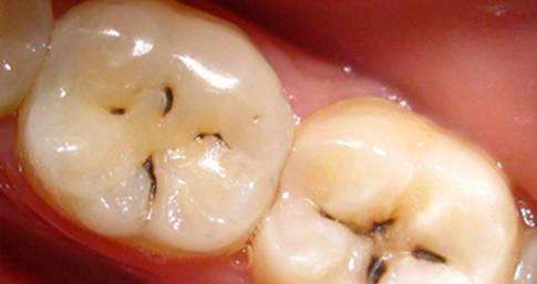 牙齿龋坏补牙能维持多久,牙齿龋坏比较严重补牙效果好吗