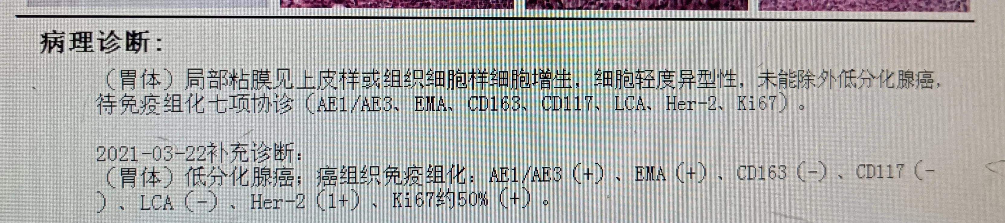 胃癌早期怎么防治,弥漫浸润性胃癌如何早发现