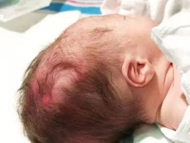 头皮血肿半年会变成瘤吗,产瘤和血肿的区别ppt