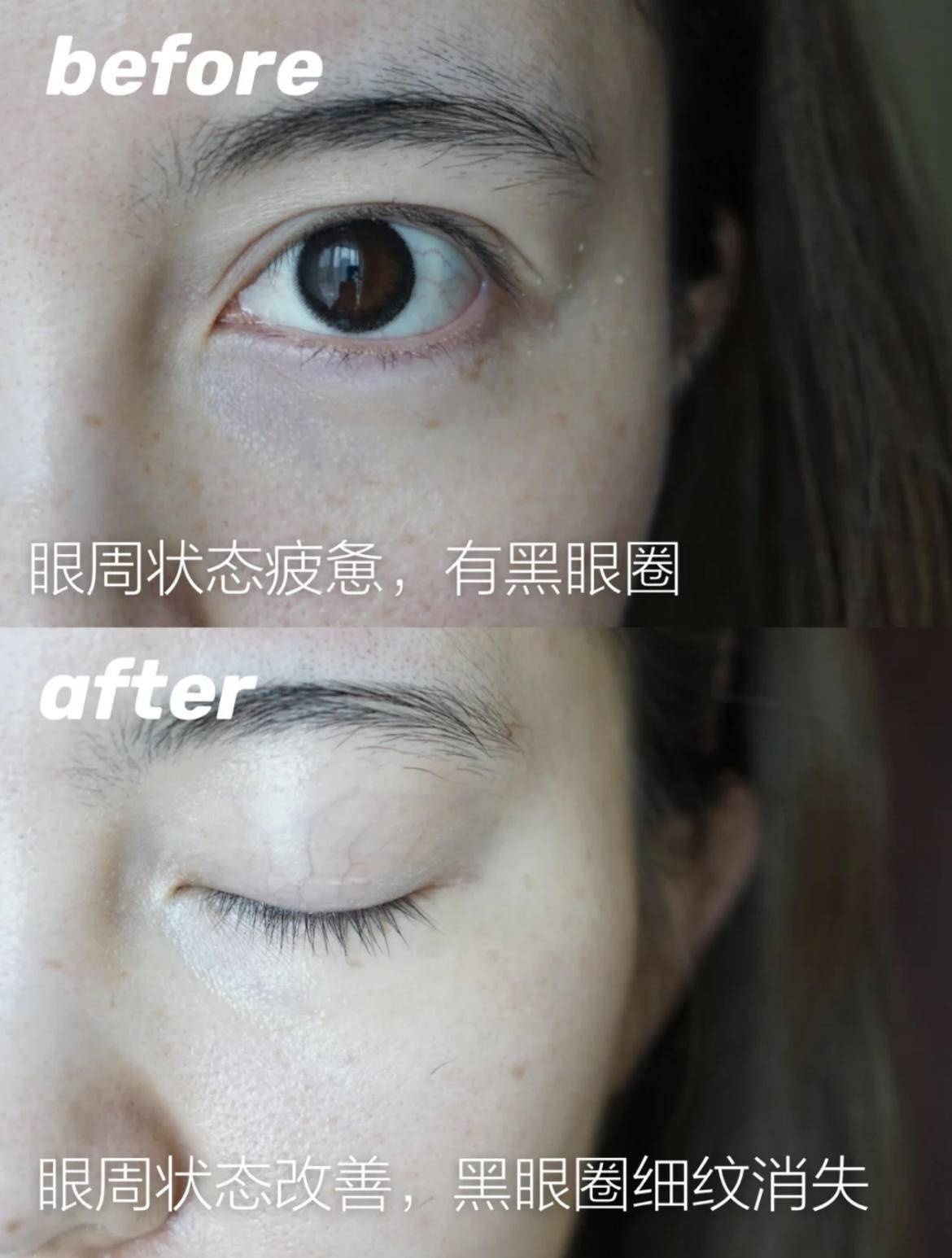 眼部有细纹用眼膜有用吗,眼部细纹眼膜有用吗