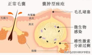 青春痘治疗最佳中成药,青春痘最好的治疗方案