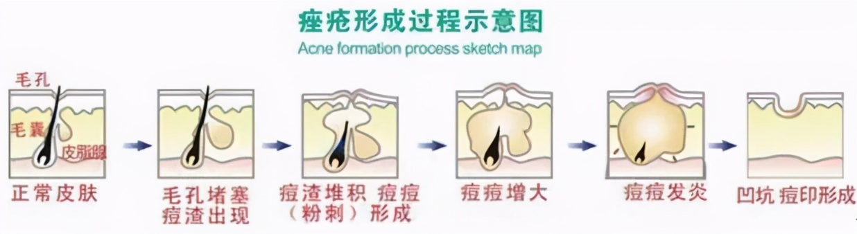 老中医推荐的祛痘神器,推荐祛痘痘神器13岁