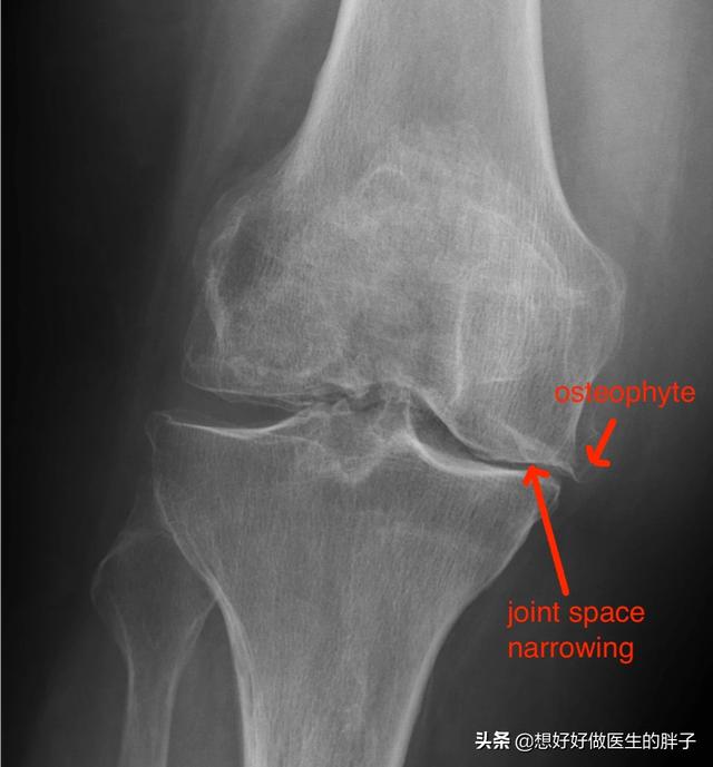 膝盖怎样知道有骨刺,膝盖有骨刺中医怎么治